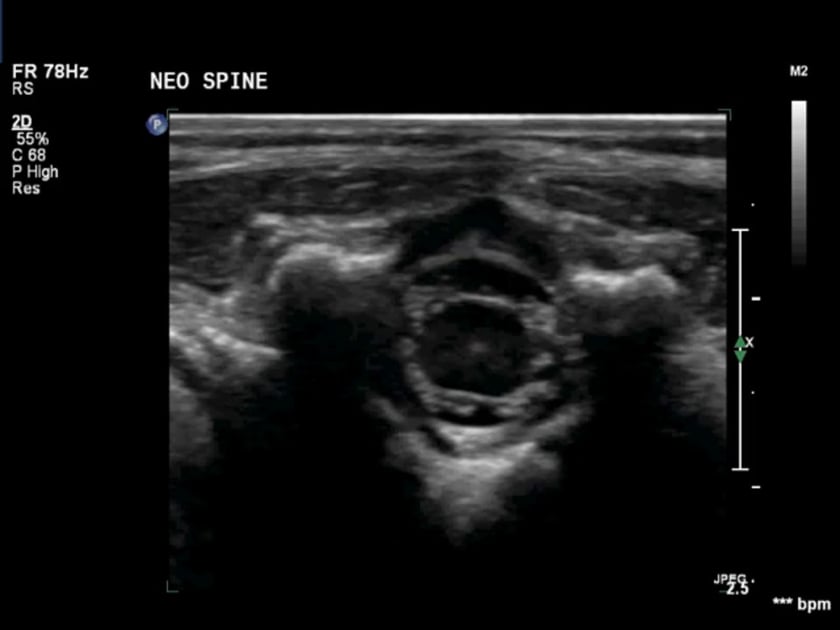 sacral dimple ultrasound