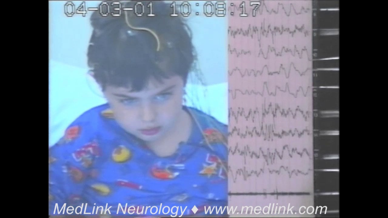 Nonconvulsive status epilepticus in epilepsy with myoclonic-atonic seizures (video-EEG)