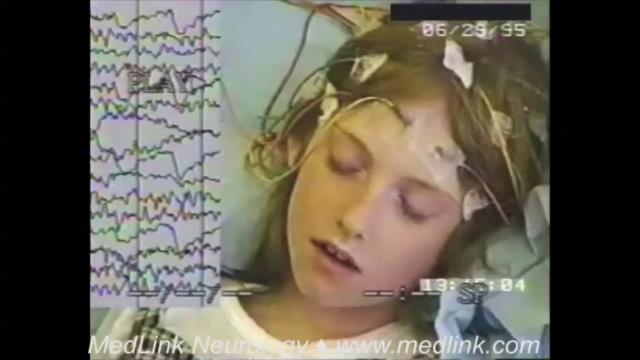 Eyelid myoclonia in a child (video-EEG)