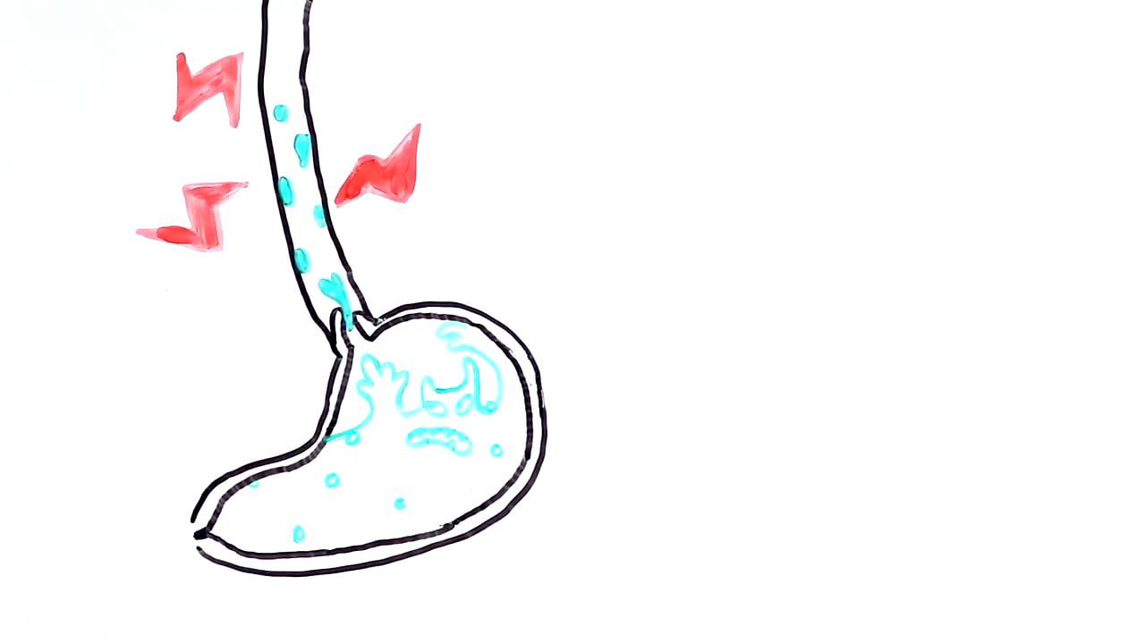 Antacid vs H2 Antagonist vs PPI Pfizer Training on Vimeo