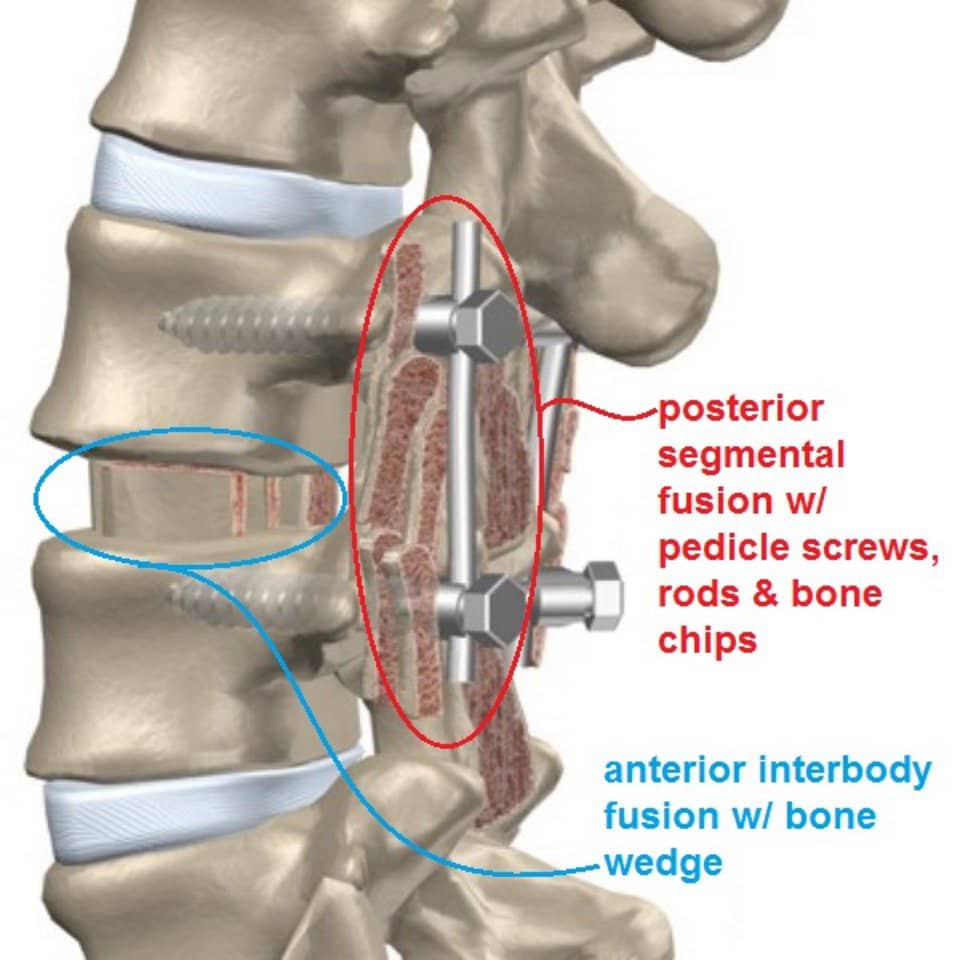 l4-l5-and-l5-s1-tlif-for-multi-level-bilateral-foraminal-stenosis-due