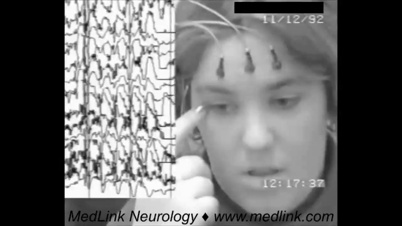 Perioral myoclonia (of mainly repetitive jaw jerks) with absences misdiagnosed as focal motor seizures
