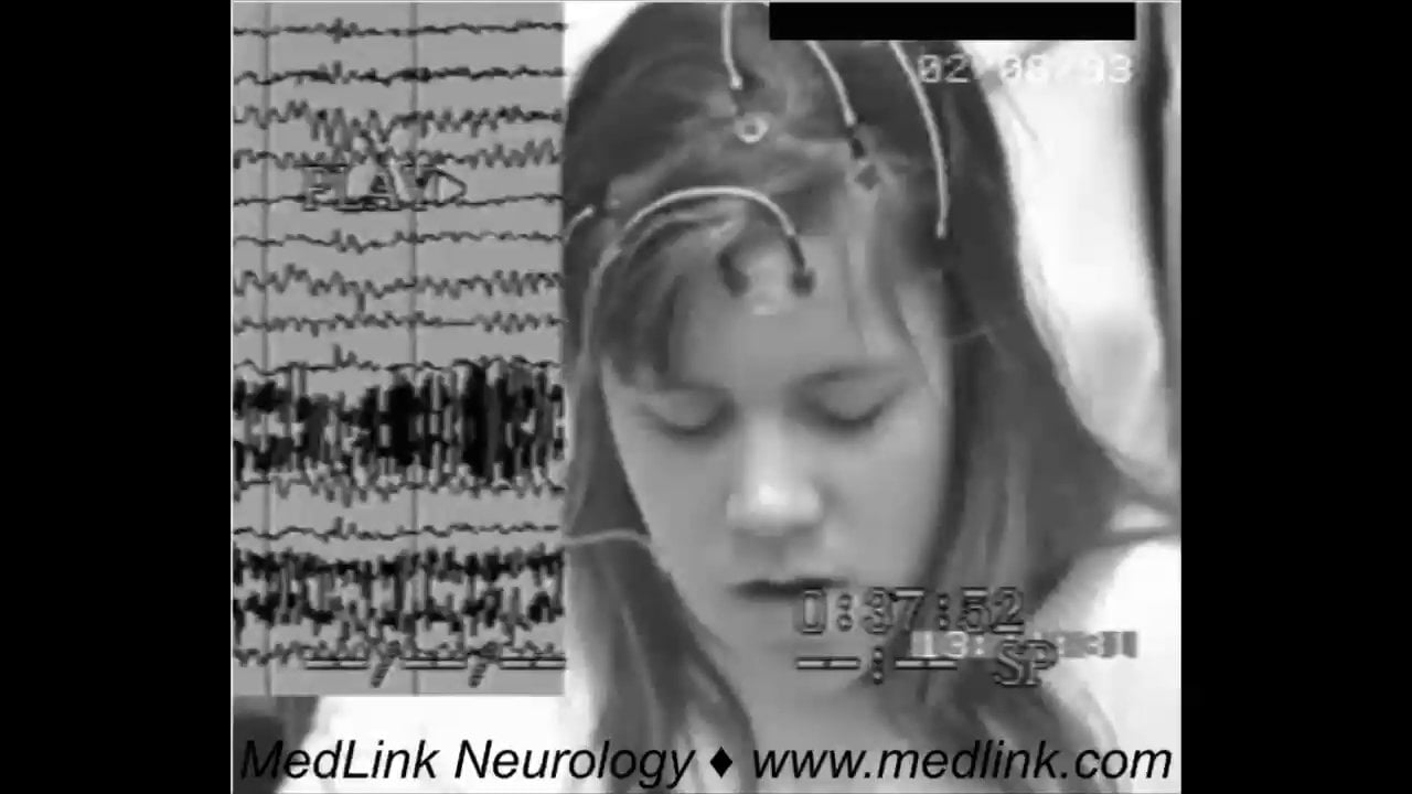Absence seizures with single myoclonic jerks | MedLink Neurology