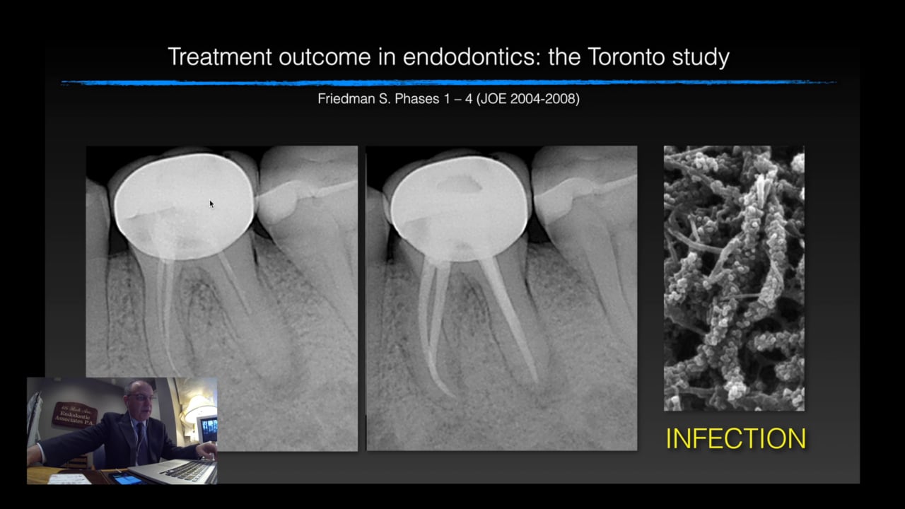 What Makes Endo Go Bad?! Real World Endo Endodontics Educational Videos