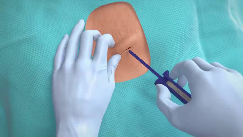 Medtronic reveal linq insertable cardiac monitor icm system on vimeo