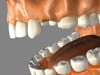 Dental Education Video - Bonded Bridge for Tooth Replacement