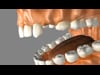 Dental Education Video - Bonded Bridge