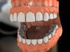 Dental Education Video - Immediate Dentures (Placed Right After Teeth Extraction)