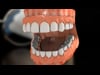 Dental Education Video - Full Arch Dentures