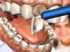Dental Education Video - Placing Porcelain Veneers