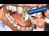 Dental Education Video - Dental Veneers