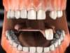 Dental Education Video - Partial Dentures