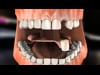 Dental Education Video - Flexible Partial Dentures