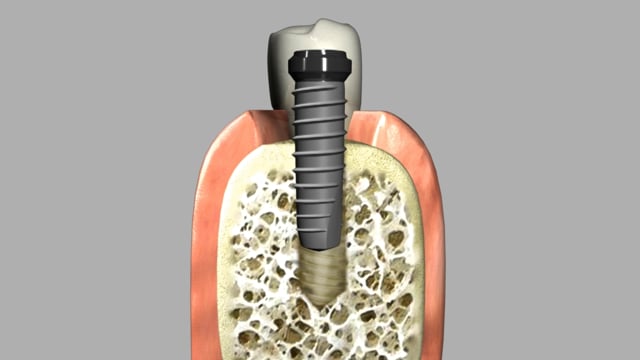 Implant Placement
