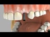 Single Tooth Implant