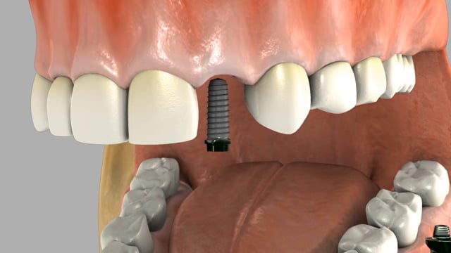 Single Tooth Implants