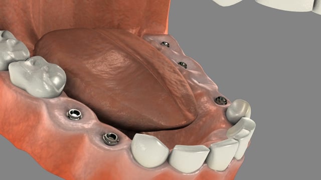 Multiple Tooth Implants