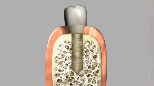 What Is A Dental Implant?