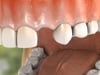 Dental Education Video - Dental Implant Placement (Steps of Implant Surgery)