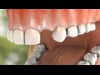 Dental Education Video - Implant Placement