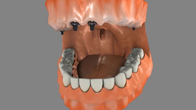 Implant Supported Dentures