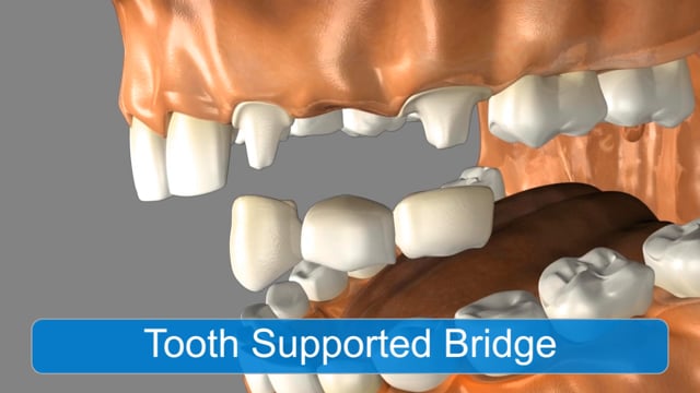 Implant Alternatives