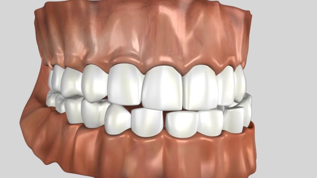Bruxism