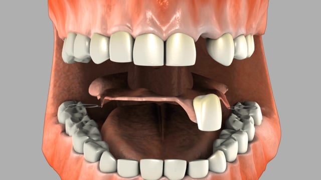 Partial Dentures