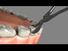 Tooth Extraction