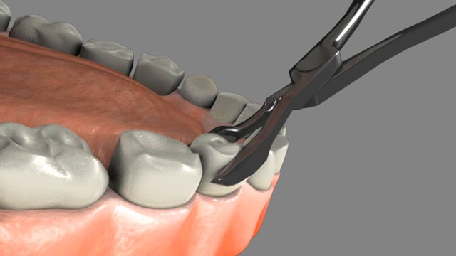 Tooth Extraction