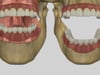 Denture Resorption