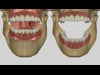 Denture Resorption