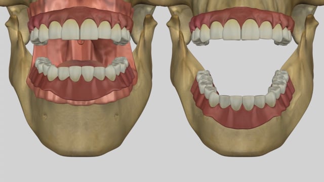 Denture Resorption