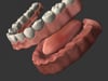 Full Arch Dentures