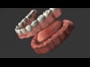 Full Arch Dentures