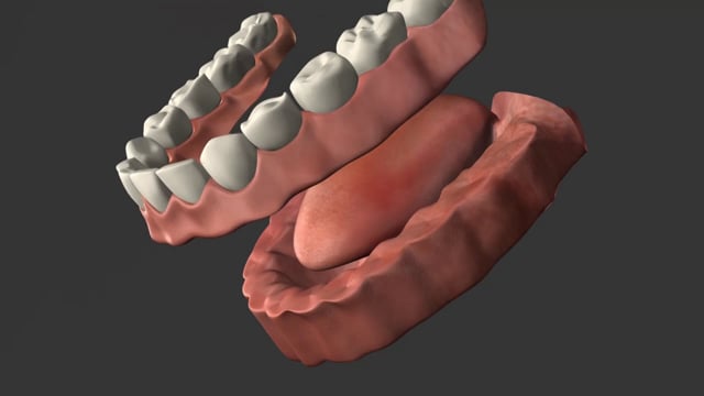 Full Arch Dentures