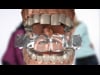 Dental Education Video - Invisalign