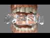 Invisalign