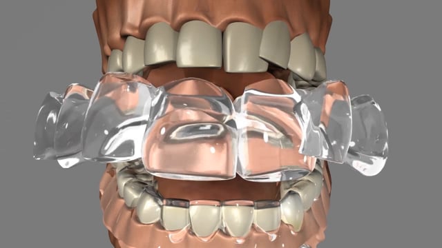 The Invisalign Process