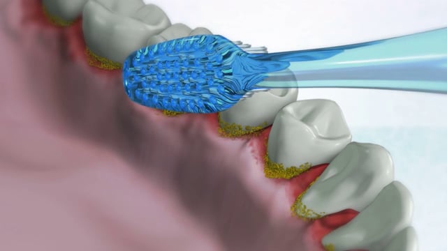 PERIOSHIELD