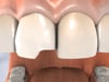 Dental Education Video - Dental Bonding Treatment