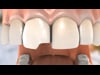 Dental Education Video - Bonding