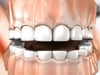 Dental Education Video - Bruxism