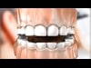 Dental Education Video - Bruxism