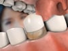 Dental Education Video - Types of Crowns