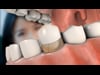 Dental Education Video - Crown Procedure