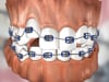 Dental Education Video - Conventional Braces
