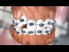 Dental Education Video - Conventional Braces