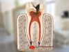 Dental Education Video - Causes of a Root Canal