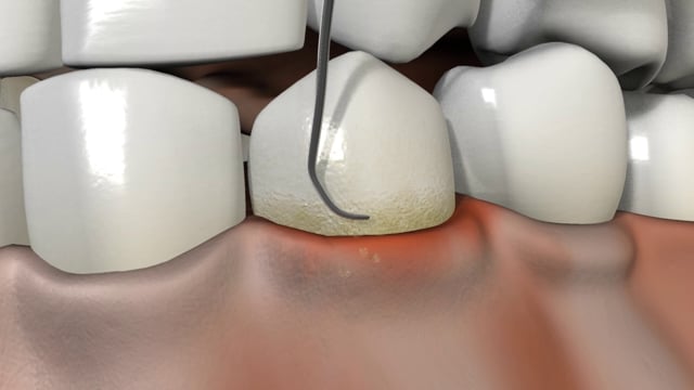 Tooth Scaling